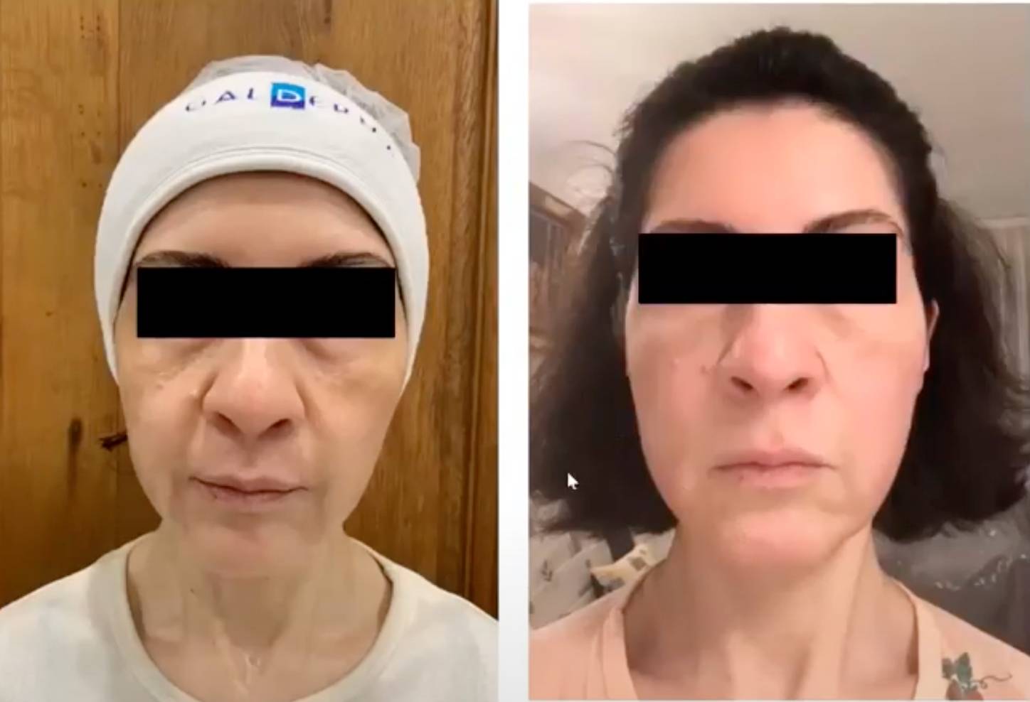 Pro Vorher Nacher3 Vorher Nachher Dermatologie Hanau